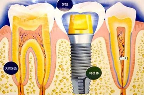 種植牙齒有什么壞處-義齒廠家