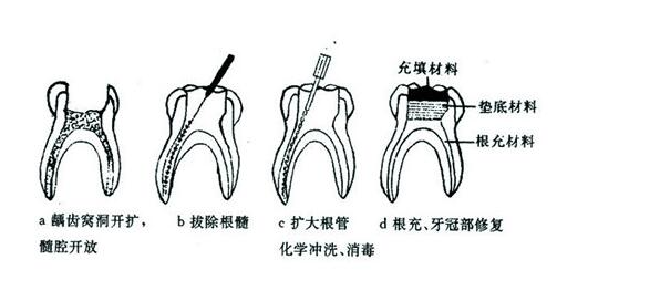 牙齒全瓷修復：美學與功能的和諧統(tǒng)一 | 成都義齒廠家